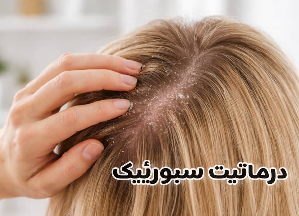 درماتیت سبورئیک چیست و چرا بدون درمان درست برطرف نمی‌شود؟